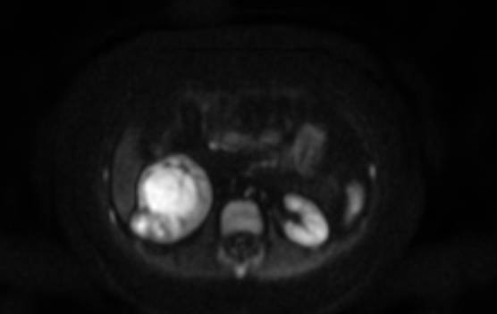 Помогите собрать на анализ онкомаркер NSE Диагноз Нефробластома - Screenshot_14.jpg