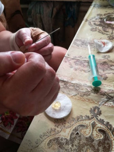 хотя тоже нужна операция.. но я не могу в синовиальную сумку плеча лезть .. хотя если бы мне дали на 2 часа операционный блок с их аппаратурой  я сама всё сделала бы..