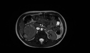 Помогите собрать на анализ онкомаркер NSE Диагноз Нефробластома - Screenshot_3.jpg