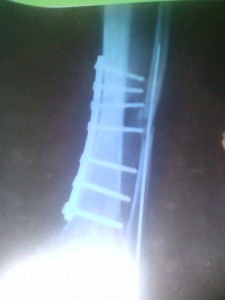 Вот нога после операции поэтому получаю пенсию